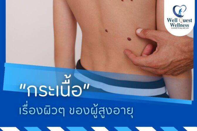 “กระเนื้อ” เรื่องผิวๆ ของผู้สูงอายุ - ศูนย์ดูแลผู้สูงอายุลาดพร้าว