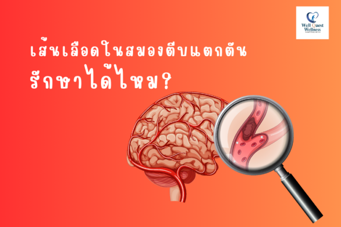 เส้นเลือดในสมองตีบแตกตัน รักษาได้ไหม?