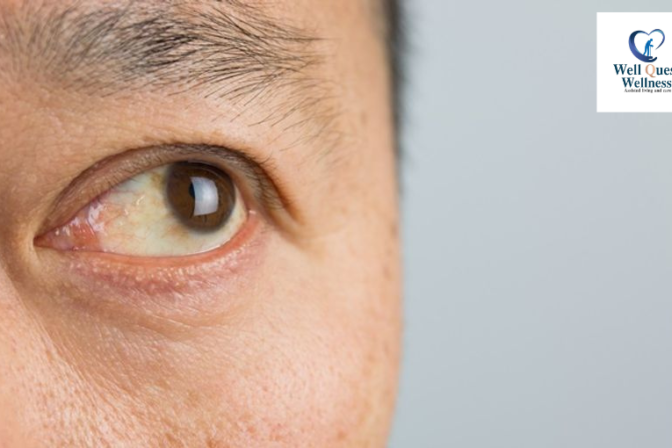 ต้อลมในผู้สูงวัย