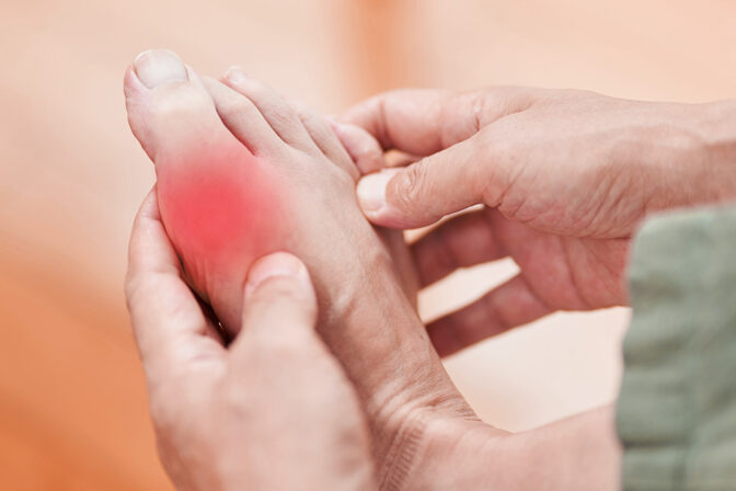 โรคเก๊าท์ โรคข้ออักเสบที่คุณไม่ควรมองข้าม