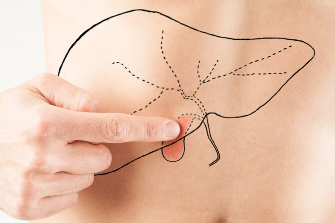 การผ่าตัดส่องกล้องนิ่วในถุงน้ำดี