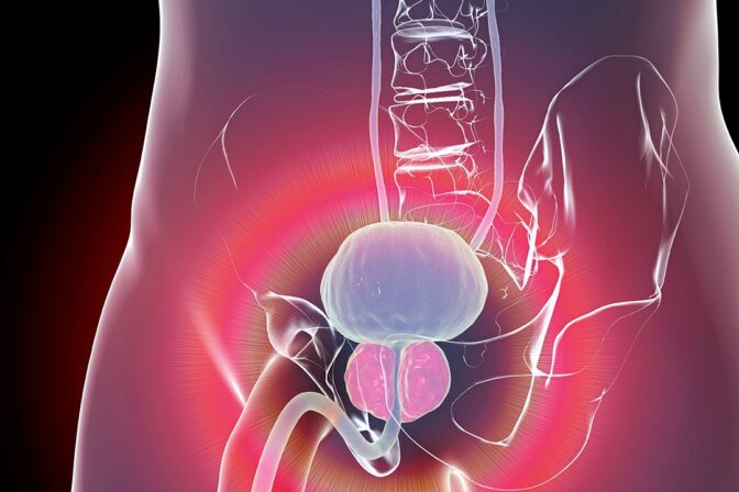 ต่อมลูกหมากโต-1